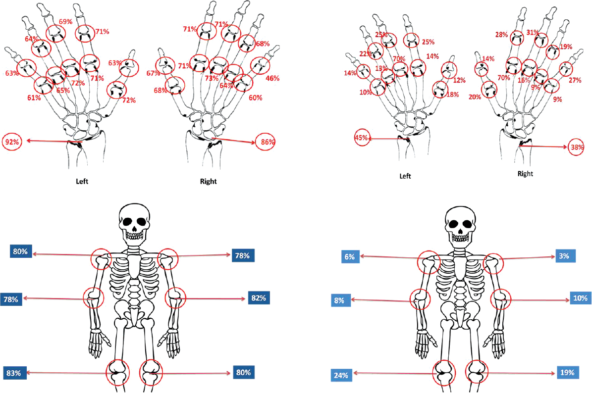 Tender joint distribution among small joints (upper panel right); and swollen joint distribution among small joints (upper panel left). Tender joint distribution among large joints (lower panel right); and swollen joint distribution among large joints (lower panel left).